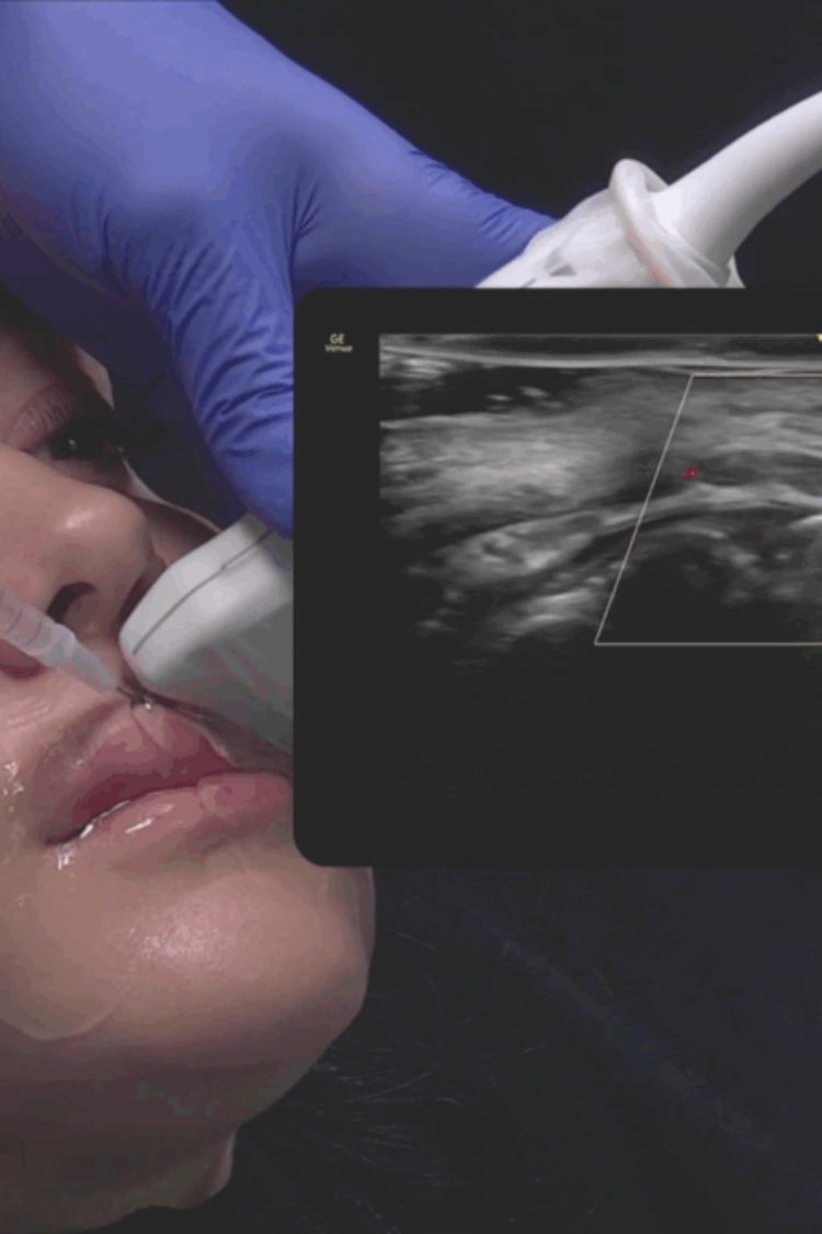 Αφαίρεση Υαλουρονικού με Υπέρηχο Θεσσαλονίκη