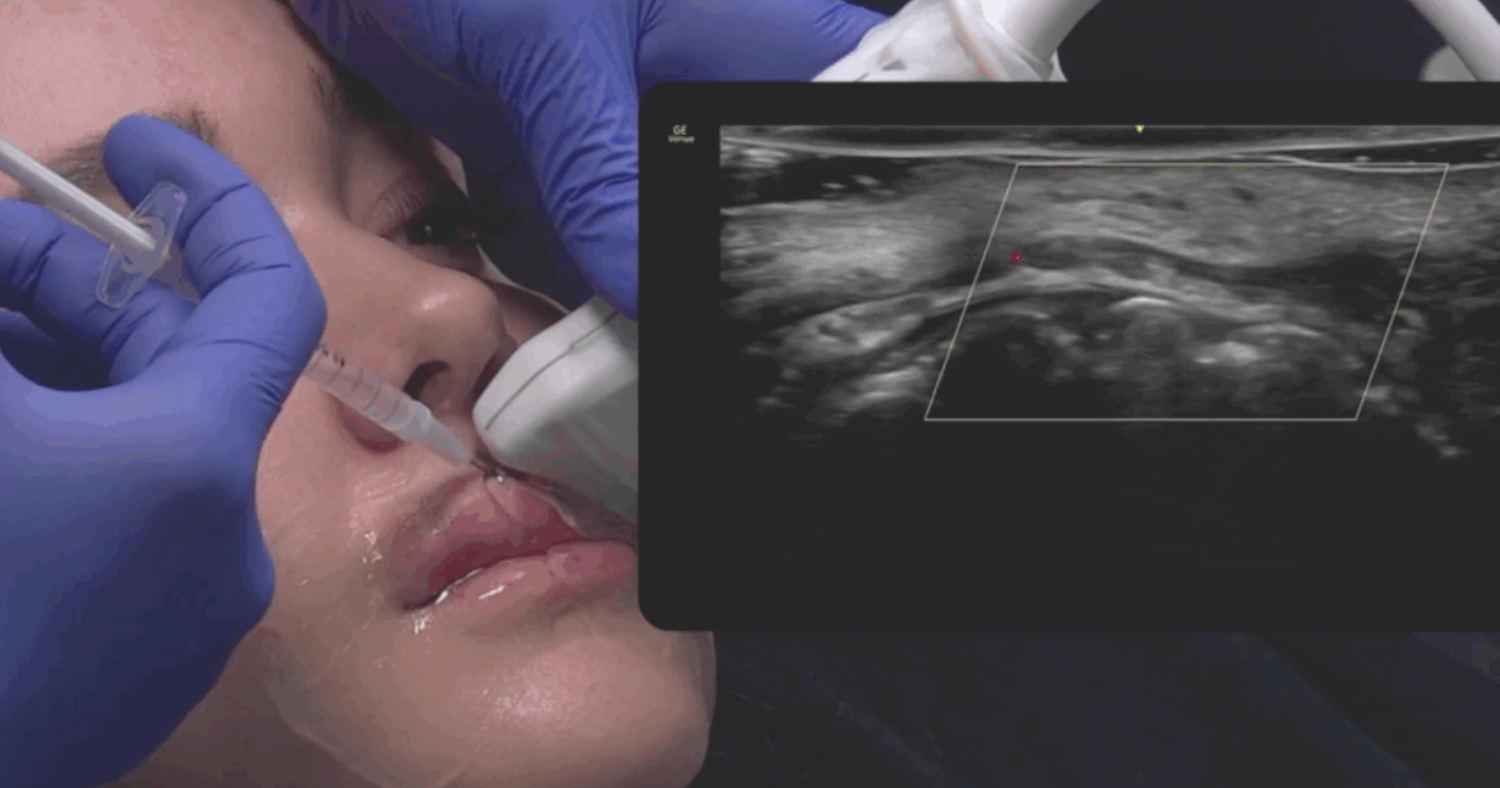 Αφαίρεση Υαλουρονικού με Υπέρηχο Θεσσαλονίκη