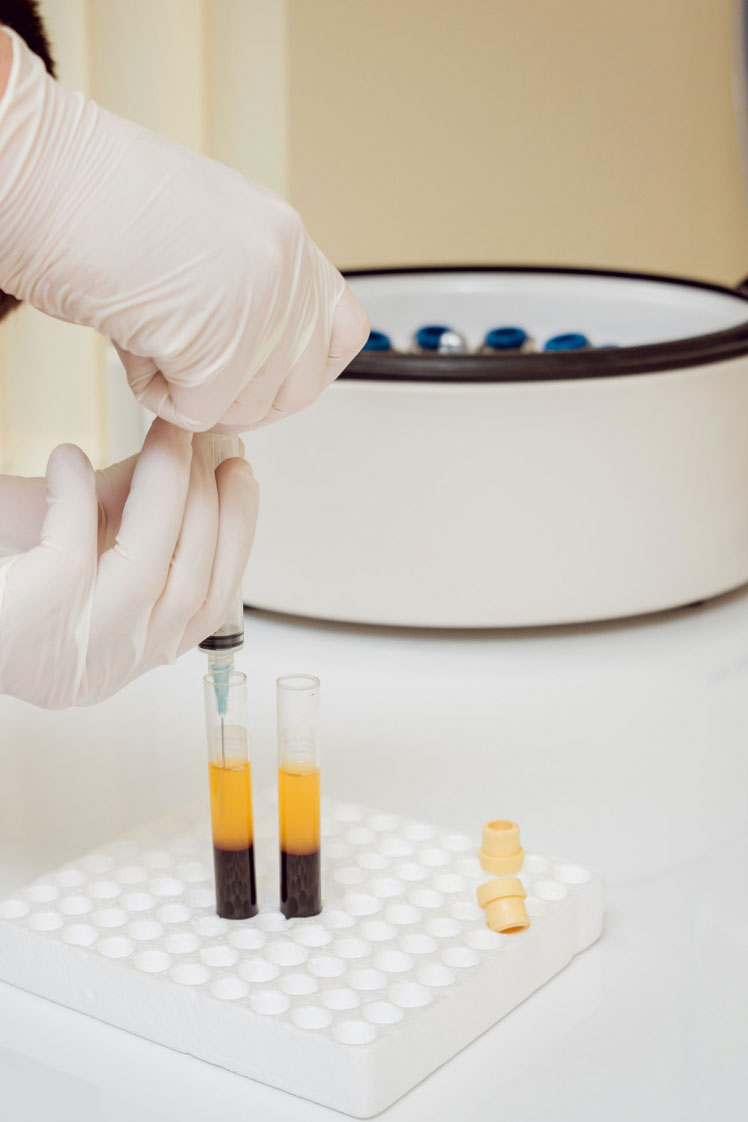 PRP (Platelet Rich Plasma) Θεσσαλονίκη