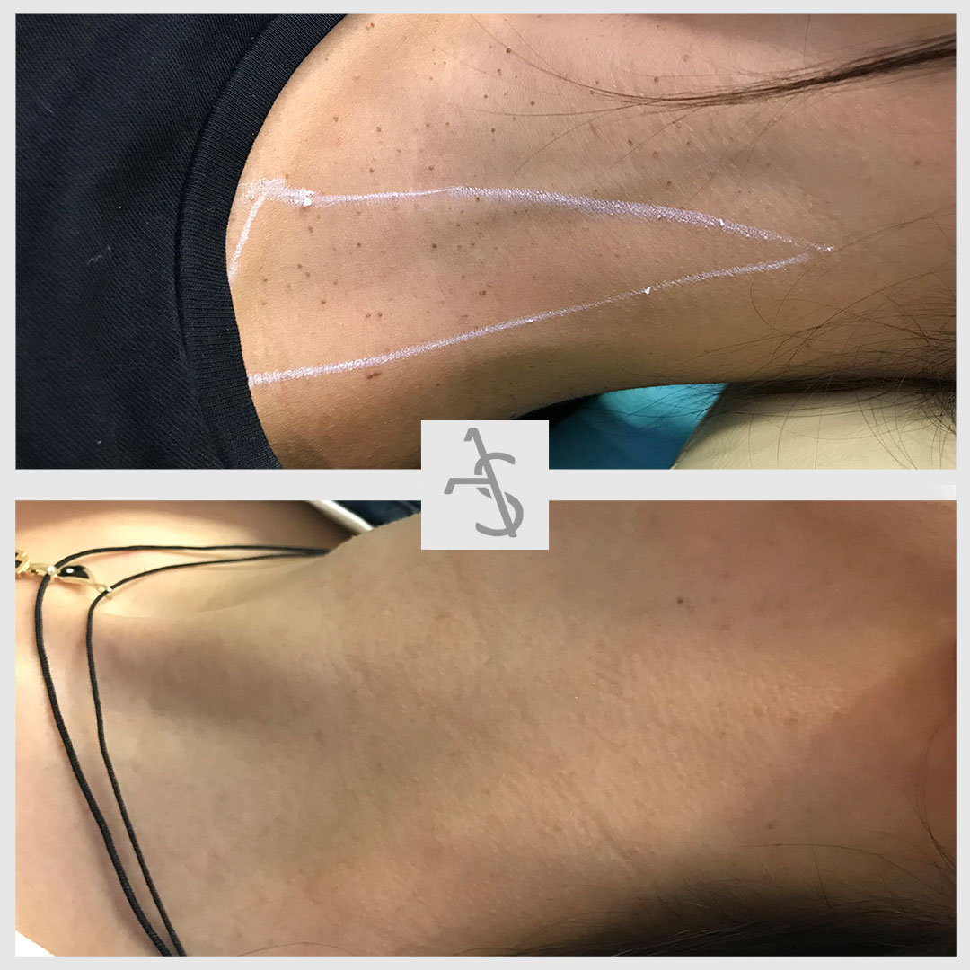 Papilloma Laser Removal, Strevinas Plastic Surgery