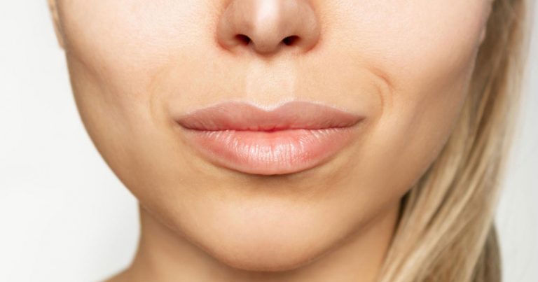 Lip Augmentation with Hyaluronic Acid