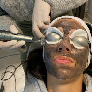 Hollywood Peel με Laser Spectra Lutronic