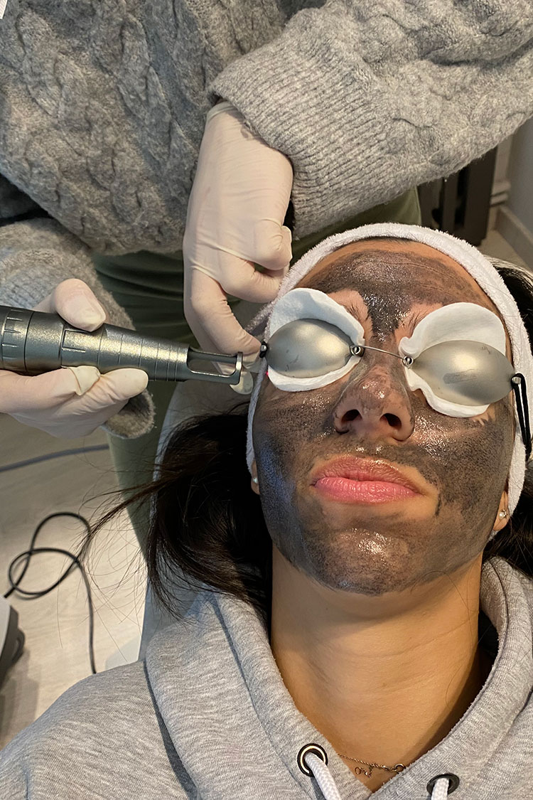 Hollywood Peel με Laser Spectra Lutronic