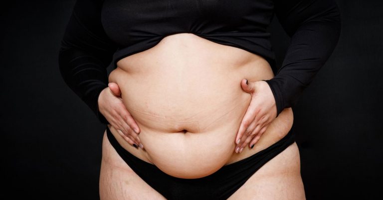 Obesity Surgery