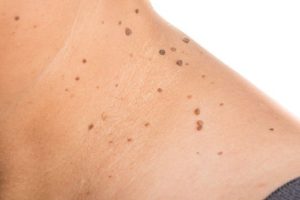 Θηλωμάτων με Laser